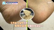 발뒤꿈치 각질, 깐 달걀 된다?, MBC 260114 방송